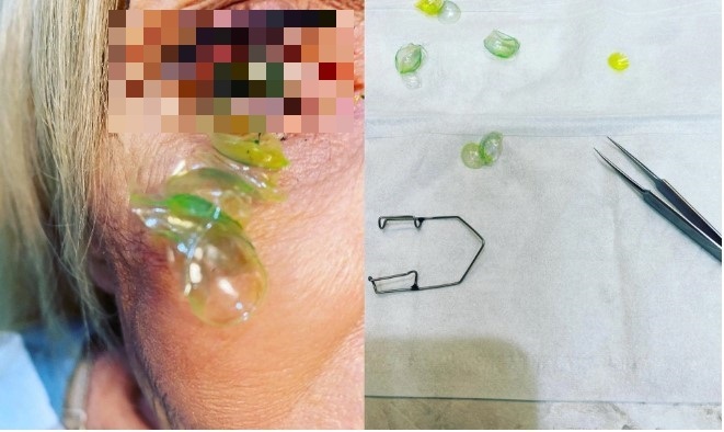 Khó tin chuyện người phụ nữ bỏ quên 23 kính áp tròng trong mắt