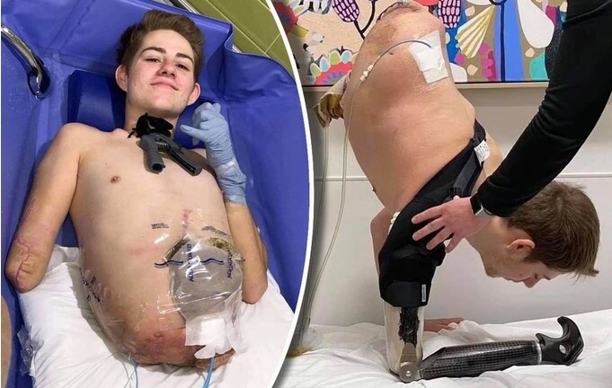 Cuộc sống hiện tại của chàng trai trẻ phải cắt bỏ nửa thân dưới khi mới 19 tuổi