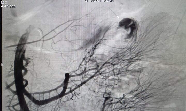 Tin tức đời sống ngày 26/10: Nam thanh niên nguy kịch do xuất huyết tiêu hóa hiếm gặp
