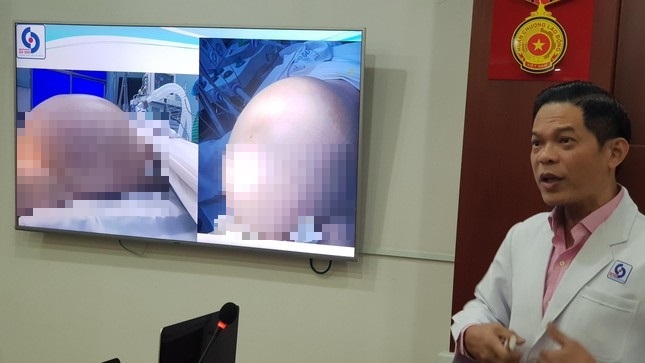 Khối u “khủng” khiến nữ sinh giống như mang bầu đến gần đến ngày sinh nở