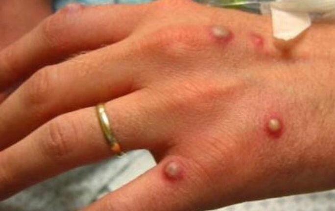 Ca nghi mắc đậu mùa khỉ ở Đắk Lắk có kết quả xét nghiệm âm tính