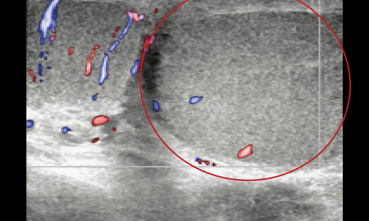 Tin tức đời sống ngày 7/11: Phẫu thuật thành công cho bệnh nhi 15 tuổi bị xoắn tinh hoàn