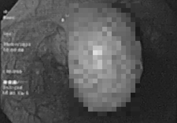 Tin tức đời sống ngày 8/11: Phát hiện mắc u cơ trơn thực quản sau gần 1 năm nuốt vướng