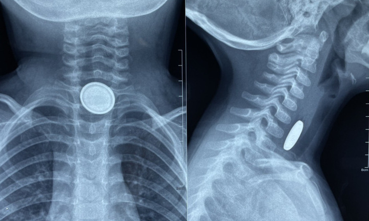 Tin tức đời sống ngày 9/11: Nội soi gắp viên pin cúc áo trong thực quản bệnh nhi 3 tuổi