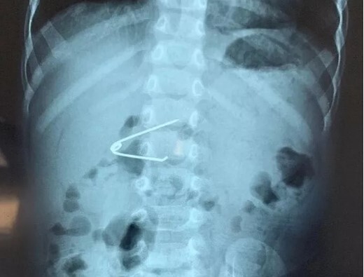 Tin tức đời sống ngày 13/11: Đầu nhọn kim băng ghim vào thành dạ dày của bé 18 tháng tuổi