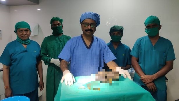 Phẫu thuật lấy búi tóc nặng 1,2kg trong dạ dày bé gái 13 tuổi