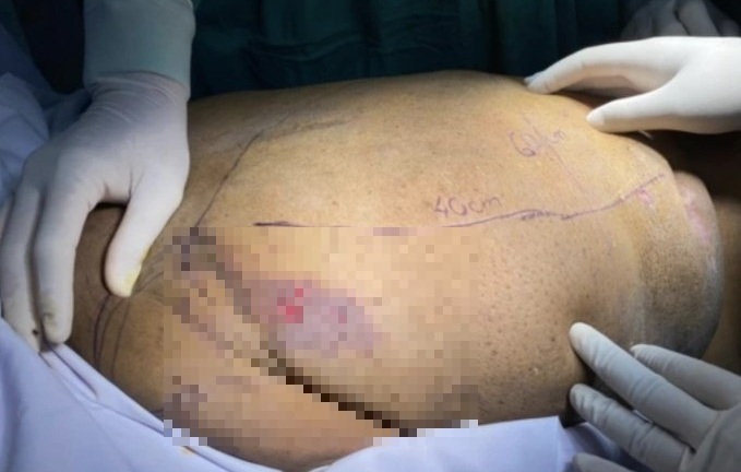 Căn bệnh hiếm gặp khiến người phụ nữ trông như đang mang “mai rùa” trên lưng