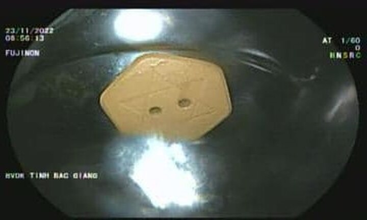 Người phụ nữ ngủ quên, nuốt luôn viên đá được quảng cáo “chữa bách bệnh”