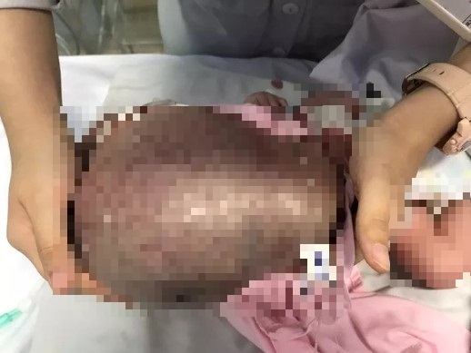 Khối bướu nặng 1,1kg chèn ép đường thở, đẩy lệch đầu bé sơ sinh sang một bên