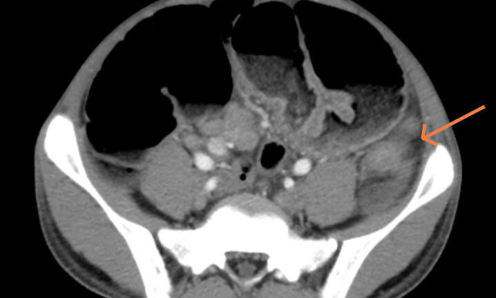 Đến viện khám vì đau bụng, bé 15 tuổi được chẩn đoán mắc ung thư đại tràng