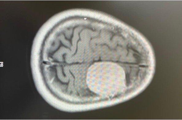 Tin tức đời sống ngày 4/12: Phát hiện khối u lớn trong não sau cơn đau đầu dữ dội