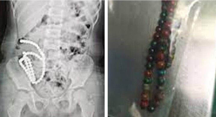 Phẫu thuật loại bỏ hơn 60 viên bi nam châm trong dạ dày bé gái 4 tuổi