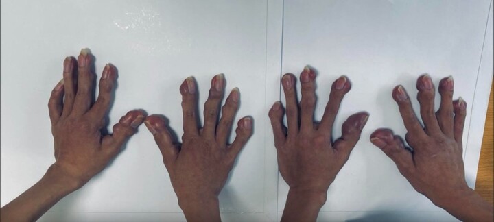 Căn bệnh hiếm gặp khiến cặp song sinh có hàng trăm khối u chi chít khắp người