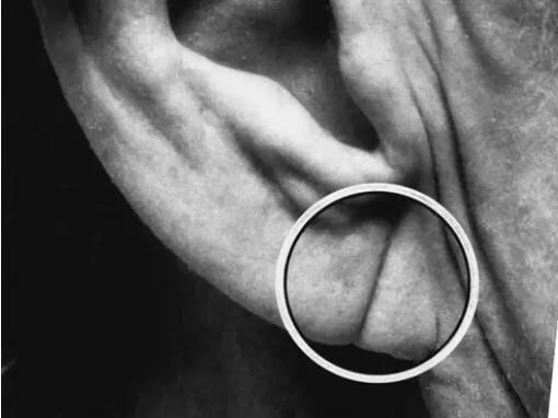 Nếp gấp lạ ở dái tai cảnh báo bệnh tim