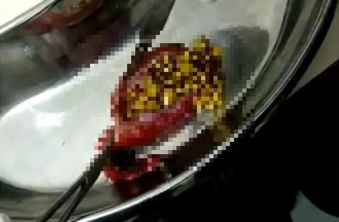 Người phụ nữ bị đau lưng nhiều tháng, đi khám mới biết có hơn 380 viên sỏi trong túi mật