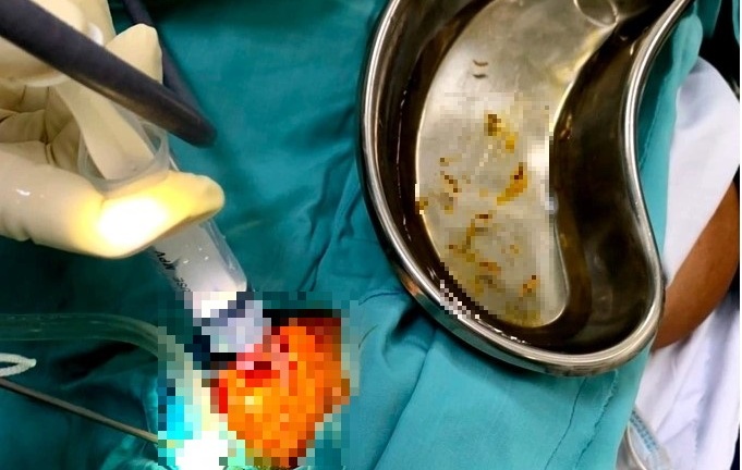 Nội soi gắp hàng chục con giòi sống trong ống tai người phụ nữ 45 tuổi