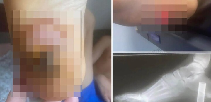 Bé trai 13 tuổi có nguy cơ mất chân vì nghịch thuốc lá điện tử