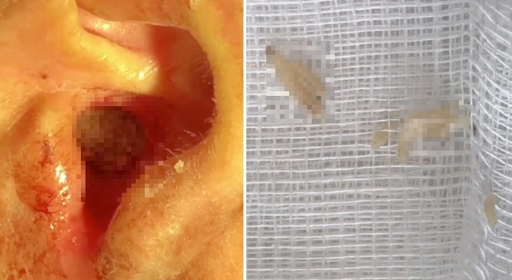 Bị chảy máu tai trái 5 ngày, người đàn ông 64 tuổi sốc nặng khi biết nguyên nhân