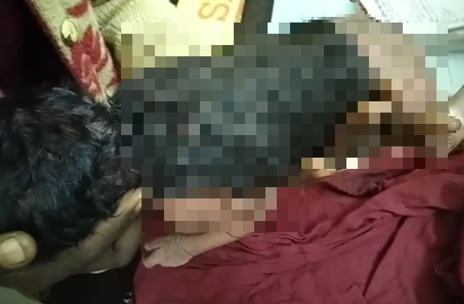 Bác sĩ sửng sốt khi bé trai chào đời với hơn nửa người phủ kín tóc