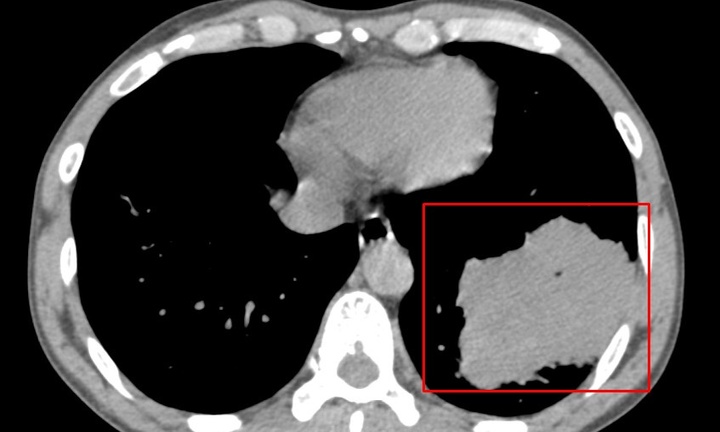 Tin tức đời sống ngày 16/1: Người đàn ông phát hiện khối u phổi lớn khi khám sức khỏe định kỳ