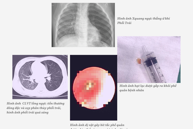 Tin tức đời sống ngày 5/2: Hạt lạc mắc kẹt gần một tháng trong khí quản bé 18 tháng tuổi