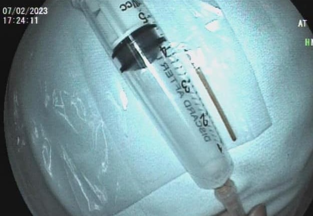 Tin tức đời sống ngày 9/2: Cụ ông 84 tuổi vô tình nuốt cây tăm khi ăn mực chiên