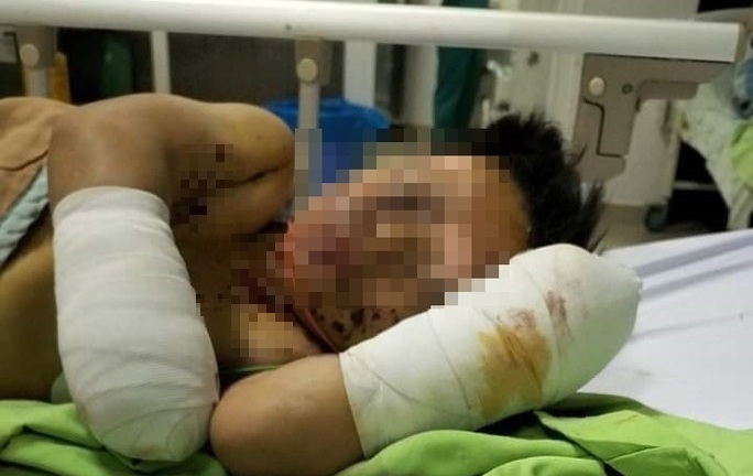 Bé trai 8 tuổi bị cụt hai bàn tay vì vật đang chơi phát nổ