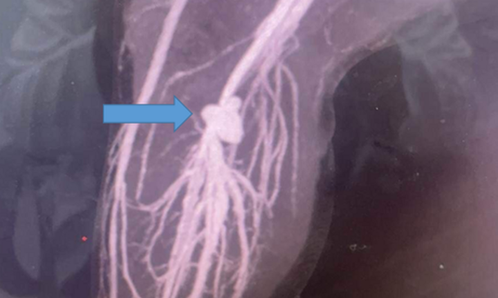 Bé trai 11 tuổi suýt phải cắt chân vì bị kéo đâm trúng khi đang chơi với em