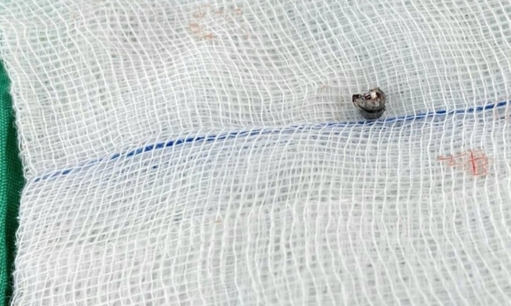 Nghịch súng hơi, bé trai 10 tuổi bị viên đạn chì găm sâu vào xương sọ