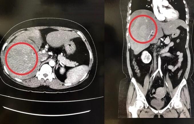Tin tức đời sống ngày 24/2: Người phụ nữ vỡ gan vì dùng vật quen thuộc này để giảm cân
