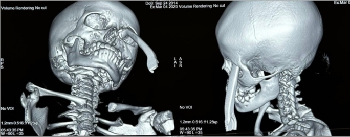 Hai bệnh viện hợp lực cứu bé gái 9 tuổi bị tay thắng xe đạp đâm vào hốc mắt