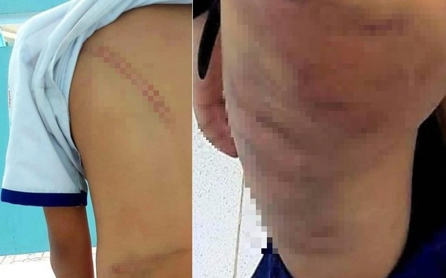 Cà Mau: Khởi tố mẹ kế đánh con chồng với hơn 20 vết bầm trên cơ thể