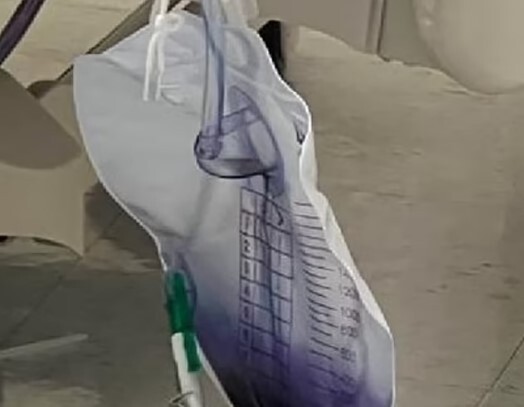 Hé lộ lý do khiến nước tiểu của cụ bà 76 tuổi chuyển màu tím kỳ lạ