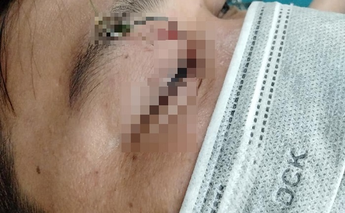 Tin tức đời sống ngày 10/4: Thanh niên 28 tuổi bị lưỡi câu cắm vào mắt