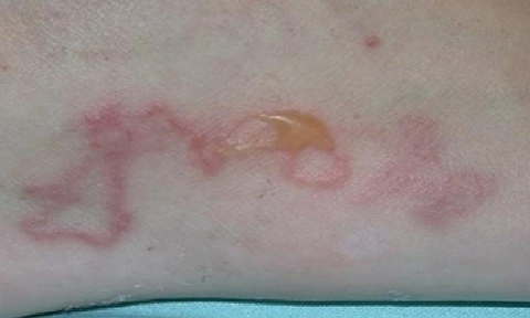 Tin tức đời sống ngày 2/5: Người phụ nữ bị ngứa 4 năm mới phát hiện nhiễm giun đũa chó mèo