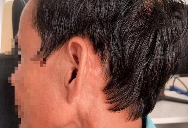 Hãi hùng phát hiện hàng chục con giòi sống lúc nhúc trong tai người đàn ông