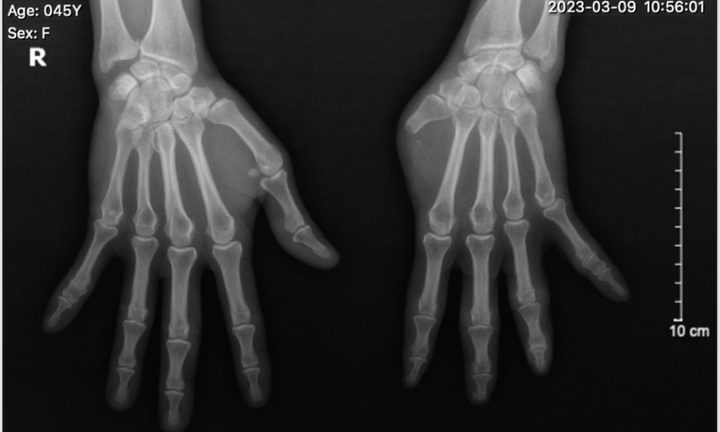 Tin tức đời sống ngày 15/5: Tái tạo ngón tay cái từ ngón chân cho người phụ nữ 45 tuổi