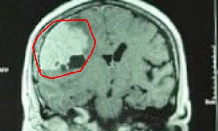 Tin tức đời sống ngày 27/5: Phẫu thuật cắt trọn khối u màng não rất lớn cho người phụ nữ