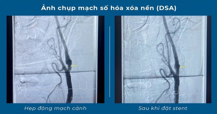 Tin tức đời sống ngày 6/7: Cứu sống người đàn ông bị đột quỵ và nhồi máu cơ tim cùng lúc