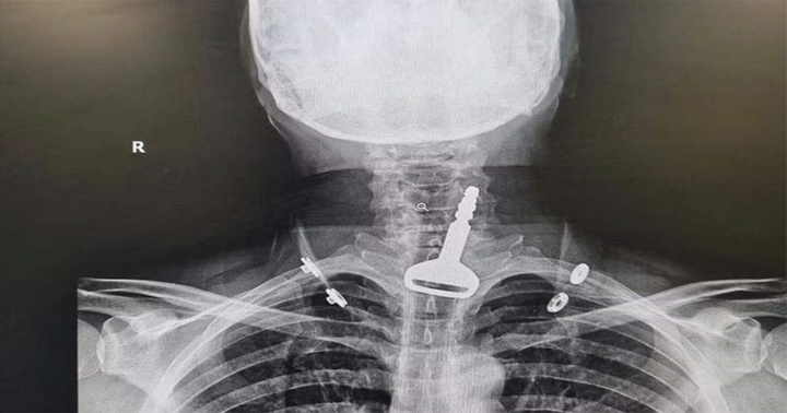 Hi hữu: Chìa khóa ô tô mắc kẹt trong đường hô hấp của người đàn ông 49 tuổi