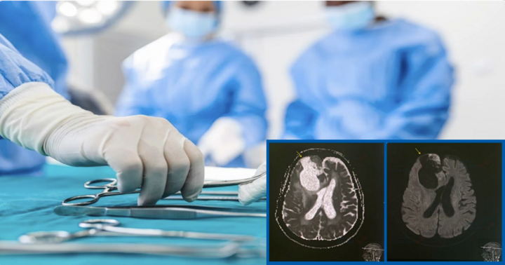 Bác sĩ tập trung cao độ trong hơn 4 tiếng, lấy khối u não “khủng” cho cụ bà 83 tuổi