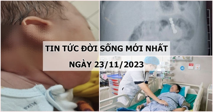 Tin tức đời sống mới nhất ngày 23/11: Bé 14 ngày tuổi có khối u lớn ở vùng cổ gáy