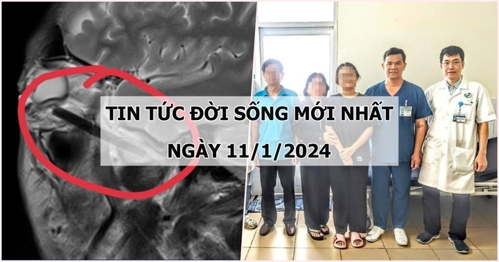 Tin tức đời sống mới nhất ngày 11/1: Phát hiện đoạn đũa gỗ dài 6m trong hốc mắt người đàn ông