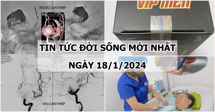 Tin tức đời sống mới nhất ngày 18/1: Cứu người phụ nữ có túi phình mạch máu não “khổng lồ”