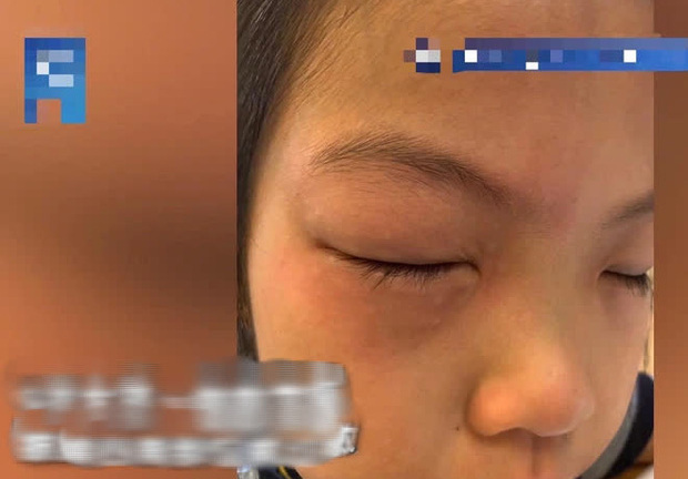 Bé gái dị ứng với bài tập toán: Cứ ngồi vào bàn là mắt sưng húp, ngứa ngáy phát khóc