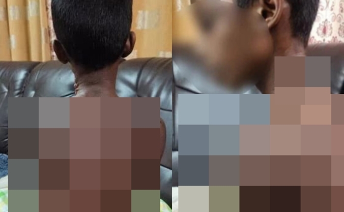 Hai đứa trẻ bị cha ruột ngược đãi dã man, thảm kịch bắt nguồn từ loại chất 