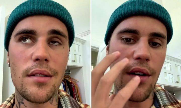 Justin Bieber bị liệt cơ mặt vì hội chứng hiếm gặp