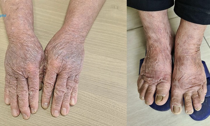 Cụ bà 73 tuổi mẩn đỏ toàn thân, nhiễm trùng do dị ứng thuốc nhuộm tóc