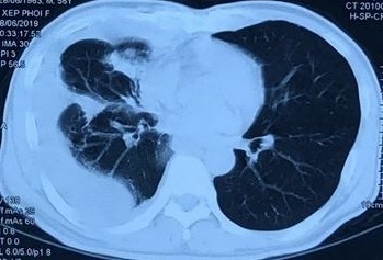 Người đàn ông phát hiện ung thư phổi giai đoạn 4 sau cơn đau ngực, ho khan