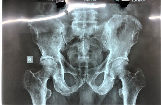 TP.HCM: Cụ ông 71 tuổi mắc kẹt trái bí đao trong hậu môn